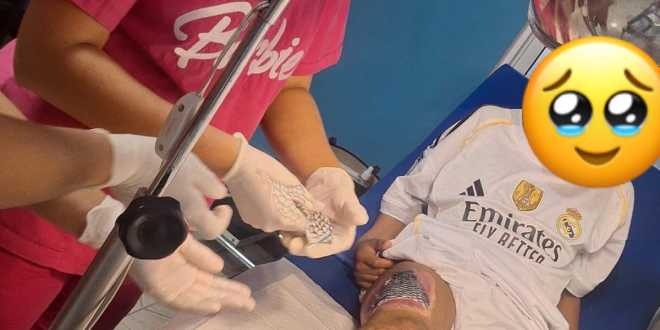 Injertan piel de tilapia en paciente con quemaduras