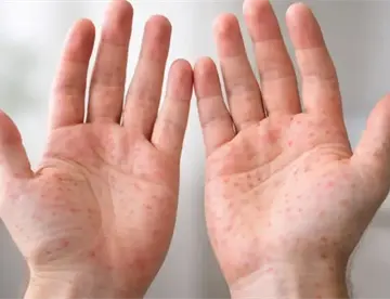 Aumenta sarampión en marzo; reportan mil 487 casos